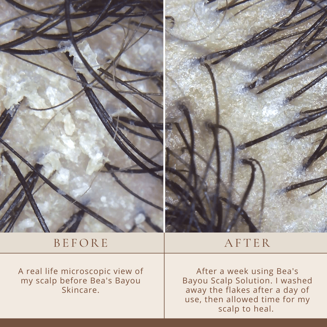 Good Biome Seborrheic Scalp Solution (DUO): Herbal Prebiotic Leave-in